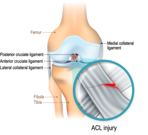 ACL Injuries: Why are they so common in Australia?